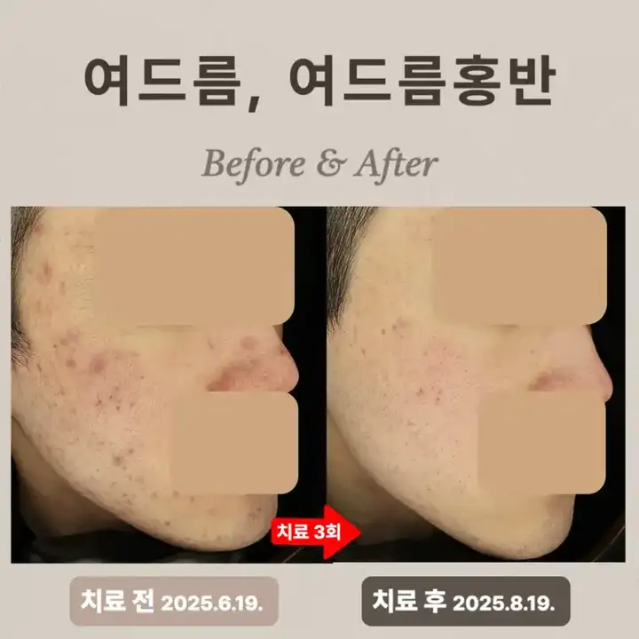 20多歲痘痘清痘·Vbeam治療案例
