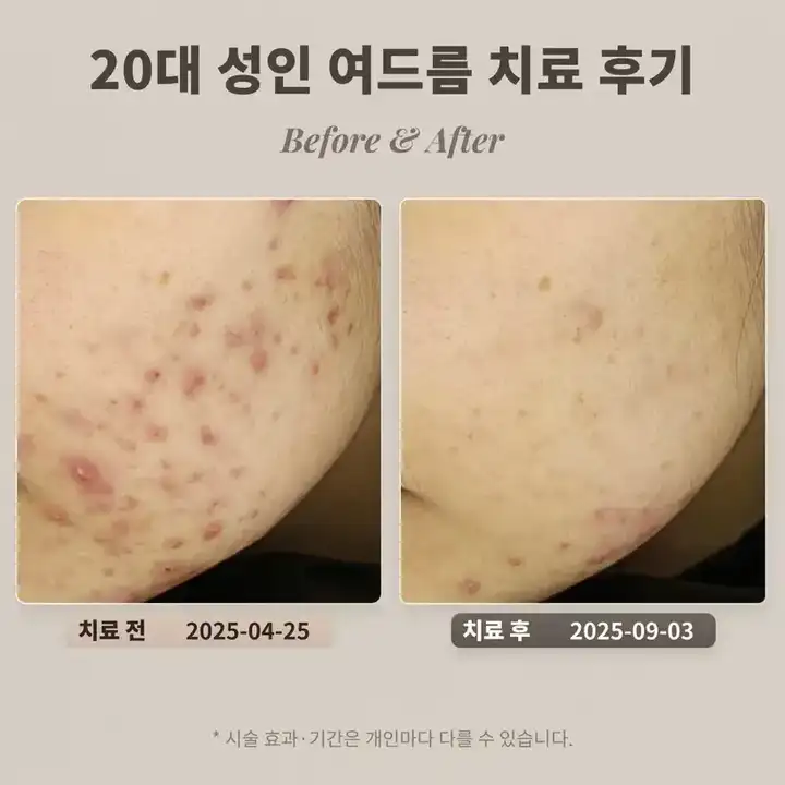 20多歲女性下巴和臉頰成人痘治療案例_大峙洞皮膚科