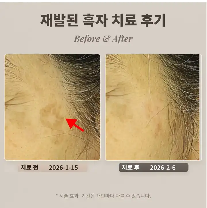 在其他醫院去除後復發的黑子治療案例