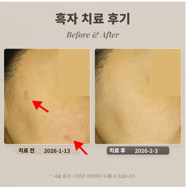 40多歲女性黑子治療案例