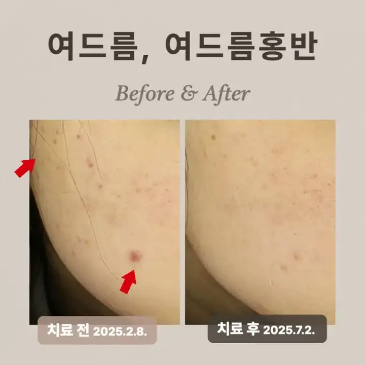20多歲紅色痘印,Vbeam治療案例與效果