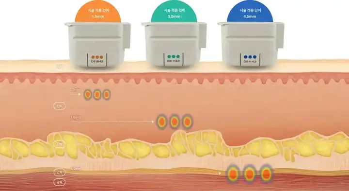 超聲刀不同探頭的治療深度