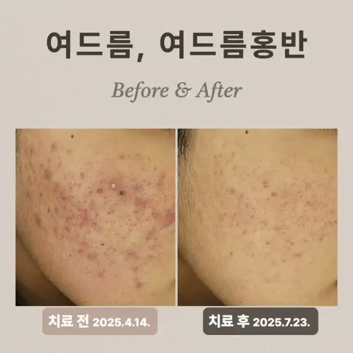 20多歲紅斑治療方法,Vbeam治療案例